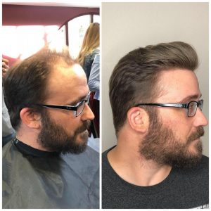 Non Surgical Hair Replacement Phoenix 300x300